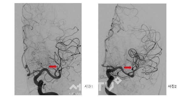 응급 뇌혈관 조영술상 중대 뇌동맥 분지부의 폐색(사진1. 화살표)이 관찰돼 뇌혈관 중재시술(흡입 혈전제거술)을 통해 1시간 이내에 완벽하게 혈전을 제거(사진2. 화살표)한 모습. (사진제공=세종충남대병원)